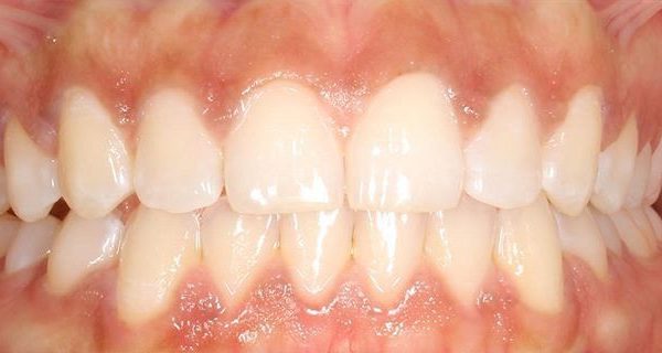 1-Invisalign-After-800h 1-Invisalign-After-800h