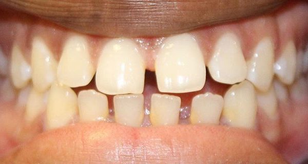 1-Invisalign-Before-800h 1-Invisalign-Before-800h