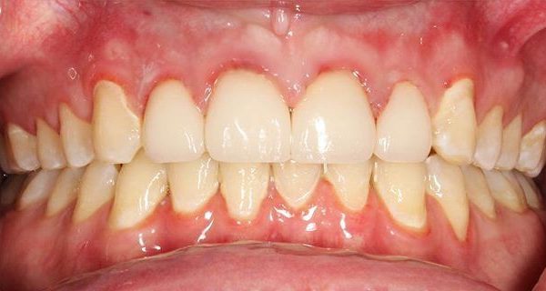 2-Smile-Makeover-After-1200w 2-Smile-Makeover-After-1200w