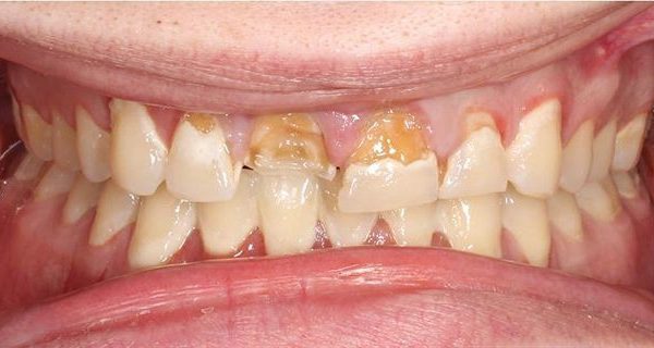 2-Smile-Makeover-Before-1200w 2-Smile-Makeover-Before-1200w
