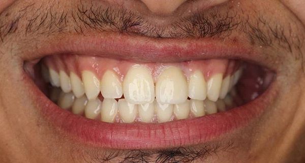 4-Veneers-After-1200w 4-Veneers-After-1200w