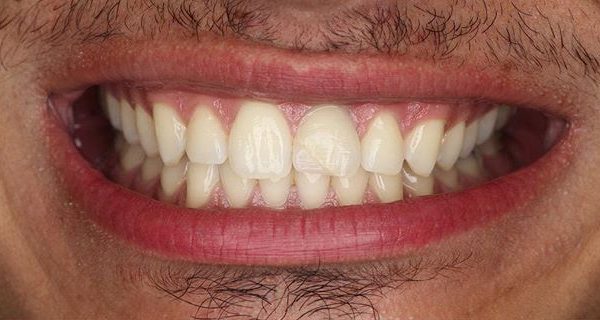 4-Veneers-Before-1200w 4-Veneers-Before-1200w