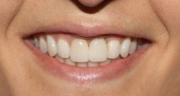 6-Implant-After-1200w 6-Implant-After-1200w