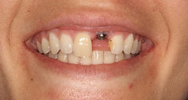 6-Implant-Before-1200w 6-Implant-Before-1200w