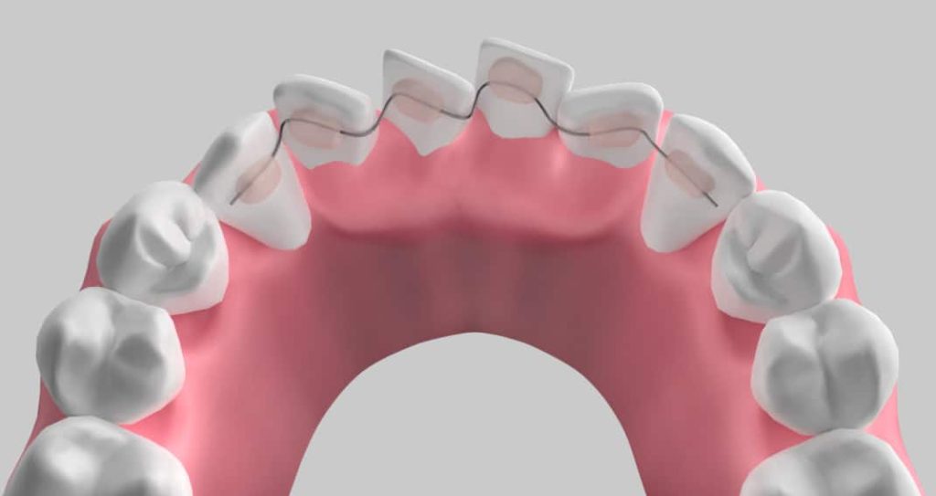 C5 Hidden Orthodontics 2 c5 braces behind front teeth